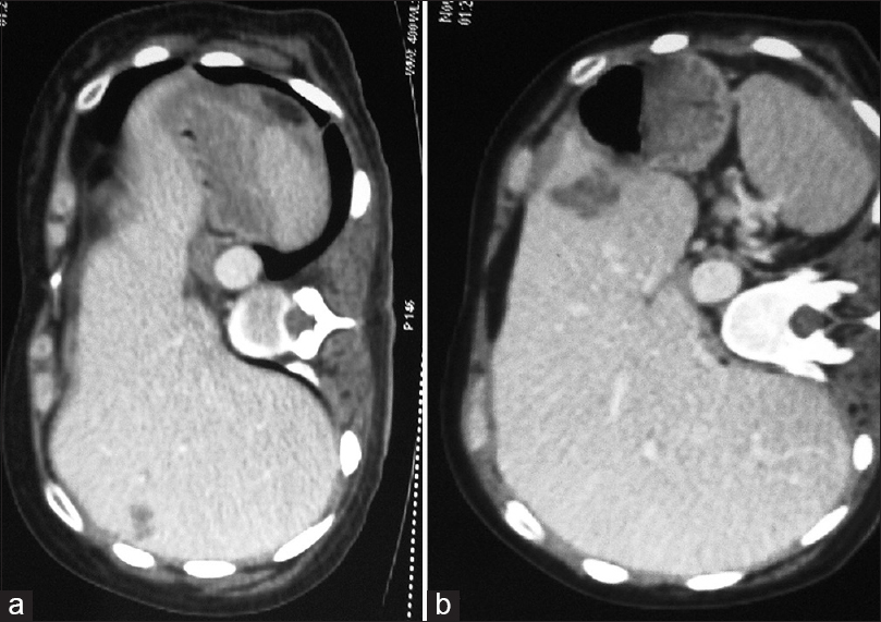 Hypodense lesion in segment 7 of the liver suggestive of metastasis (a). Hypodense lesion in segment 3 of the liver suggestive of metastasis (b)