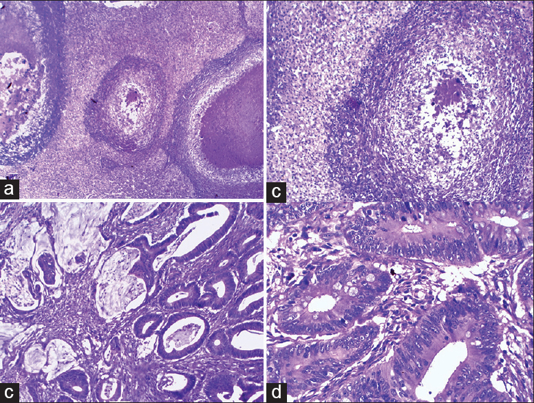 Microphotograph showing numerous confluent epithelioid granulomas effacing the normal liver architecture (H and E, ×100) (a). High power view of caseating granuloma with adjacent normal hepatocytes (H and E, ×400) (b). adenocarcinomatous glands with extracellular mucin infiltrating the muscle layer (H and E, ×100) (c). High power view showing glands lined by malignant cells having enlarged hyperchromatic nuclei, coarse chromatin and eosinophilic cytoplasm (H and E, ×400)