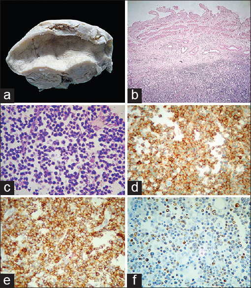 (a) Gross photograph showing nodular thickening of gallbladder wall and unremarkable mucosa. (b) Diffuse infiltrates of lymphoid cells in the adventitia of gall bladder with sparing of mucosa and muscularis (H and E, ×40). (c) Relatively uniform medium-sized atypical lymphoid cells on a background of lymphoglandular bodies (H and E, ×400). (d) Diffuse strong membranous staining of atypical lymphoid cells (CD45, ×400). (e) Diffuse strong membranous staining of atypical lymphoid cells (CD20, ×400). (f) Scattered nuclear staining of atypical lymphoid cells (bcl-2, ×100)
