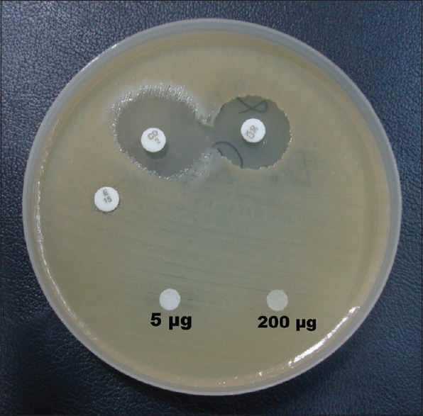 High level mupirocin resistant methicillin sensitive Staphylococcus aureus showing inducible clindamycin resistance phenotype
