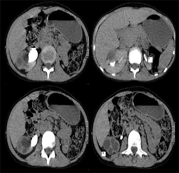 Computed tomography urography showing: (1) Enlarged right kidney with multiple round hypodense lesions (2) Right sided dilated ureter (3) Small left kidney