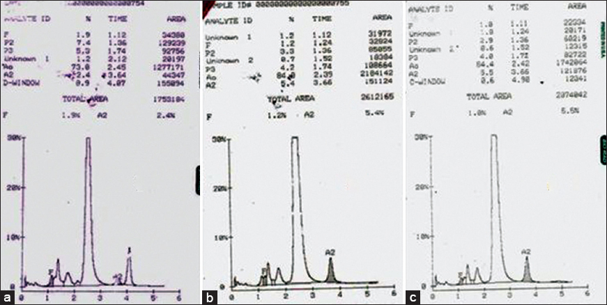 (a) Hemoglobin high-performance liquid chromatography of patient showing a peak in D-window of 8.9% with a retention time of 4.07 min. Chromatogram of father (b) and mother (c)