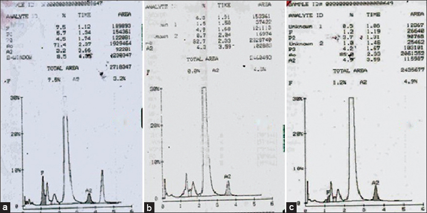 (a) Hemoglobin high-performance liquid chromatography of patient showing a peak in S-window of 8.5% with a retention time of 4.39 min. Chromatogram of father (b) and mother (c)