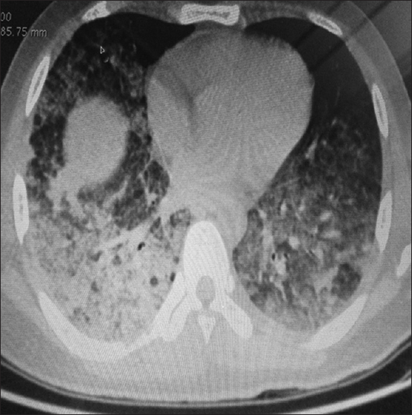 Computed tomography of chest revealing bilateral air space consolidation, ground glass opacities, bilateral parenchymal lesions suggestive of bilateral pneumonitis