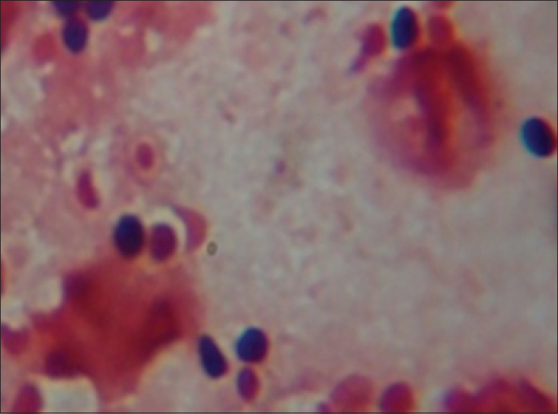 Gram's stain smear of pleural fluid sample showing broad base budding yeasts cells and exudate