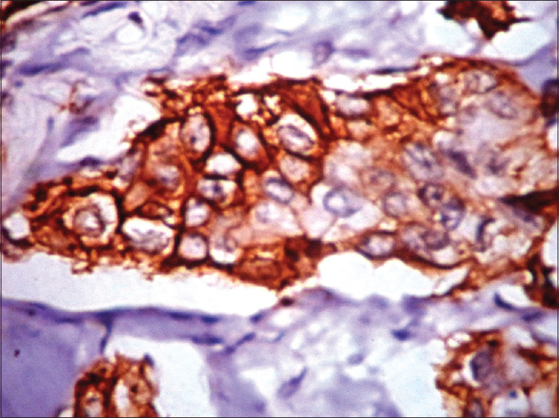 Epidermal growth factor receptor (membrane positivity) by immunohistochemistry (IHC) in triple negative breast carcinoma (IHC, ×40)