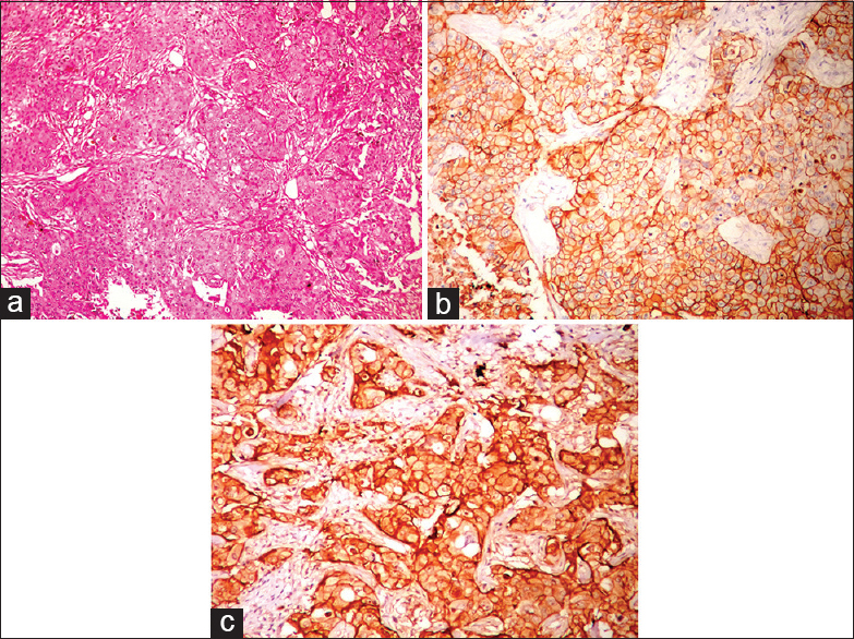 (a) Histopathology showing infiltrating ductal carcinoma with tumor cells in sheets (H and E, ×10); (b) human epidermal growth factor receptor (HER)-2/neu expression (membrane positivity) by immunohistochemistry (IHC) (IHC, ×40); (c) epidermal growth factor receptor expression in HER-2/neu breast carcinoma by IHC (IHC, ×40)