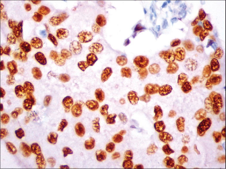 Progesterone receptors expression (nuclear staining) by immunohistochemistry (IHC) in luminal B type (IHC, ×40)