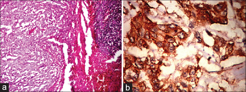 (a) Histopathology of medullary carcinoma with large tumor cells in syncitial pattern (H and E, ×10); (b) epidermal growth factor receptor expression (membrane positivity) by immunohistochemistry (IHC) in medullary carcinoma (IHC, ×40)