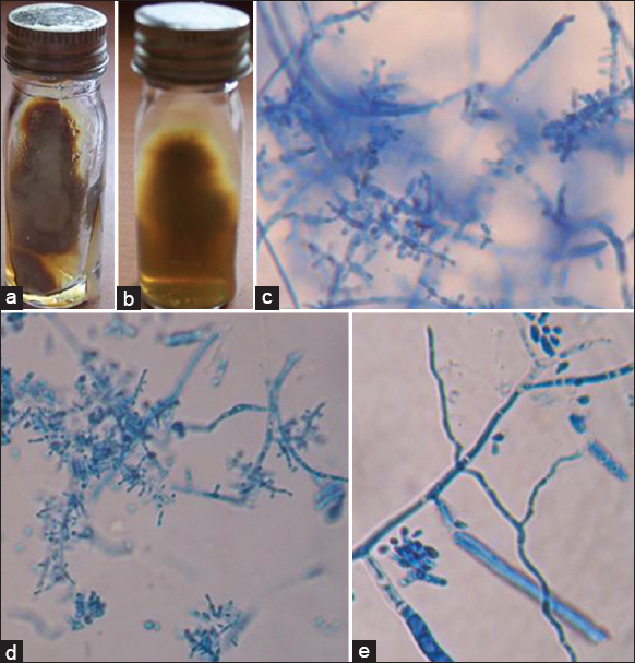 Trichophyton tonsurans. (a) Growth on Sabouraud's dextrose agar (obverse). (b) Growth on Sabouraud's dextrose agar (reverse). (c) Lacto phenol cotton blue mount showing microconida (×400). (d) Lacto phenol cotton blue mount showing match stick like microconidia (×400). (e) lacto phenol cotton blue mount showing macroconidia (×400)