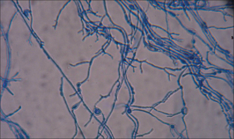 Trichophyton schoenleinii. Lacto phenol cotton blue mount showing antler hyphae and chlamydospores (×400)