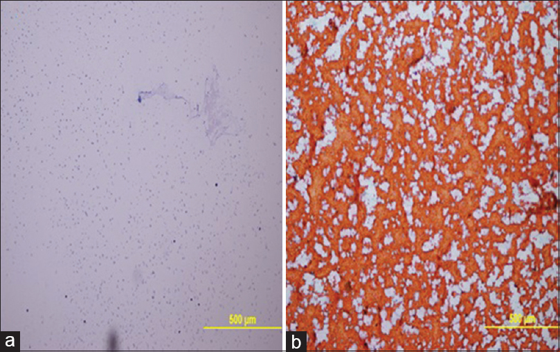 Thyroid FNA. Clean background was observed in UF-PAP stain (a) whereas hemorrhagic background was observed in the standard PAP stain (b). (×100)