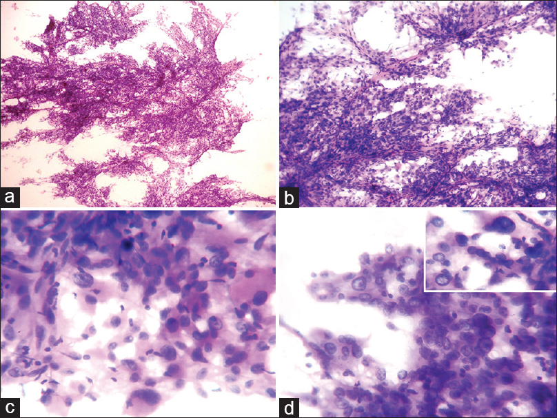 Cytology (H and E): (a) Loose cohesive cell clusters with many thin vascular capillaries and few dispersed cells (×40). (b) Variable sized tumor cells aligned to the vessels with the meshing of thin hair-like processes, along the direction of squash smear (×100). (c) Pleomorphic tumor cells show eccentric large atypical nuclei, fine granular chromatin, occasional distinct nucleoli and abundant granular eosinophilic cytoplasm (×400). (d) Few binucleation and multinucleation in tumor cells are seen. Inset figure highlights a giant bizarre tumor cells and intranuclear inclusion (×400)