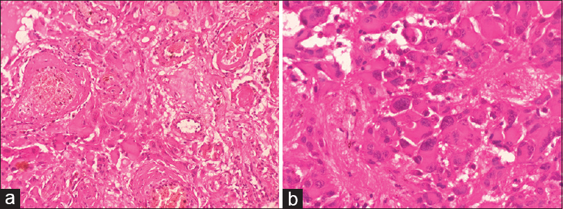 Histology (H and E): (a) Large tumor cells are closely intermingled with variable sized blood vessels (×200). (b) Tumor cells are large, round to polygonal, displaying eccentric pleomorphic nuclei, fine granular chromatin, occasional prominent nucleoli and abundant eosinophilic cytoplasm with a well-defined border. Binucleation and multinucleation in tumor cells with fibrillary areas are seen (×400)