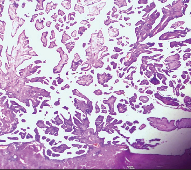 Microphotograph showing papillary projections arising from cyst wall (H and E, ×100)