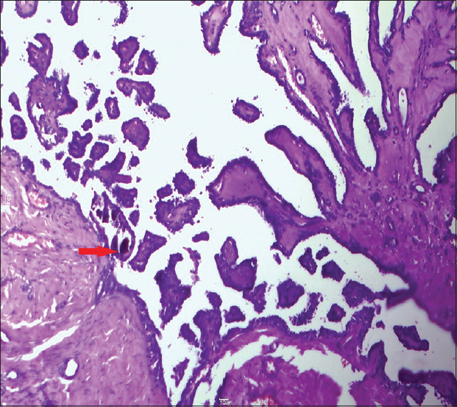 Microphotograph showing papillary projections with broad fibrovascular core along with presence of psammoma bodies in the core of papillae (red arrow) (H and E, ×400)