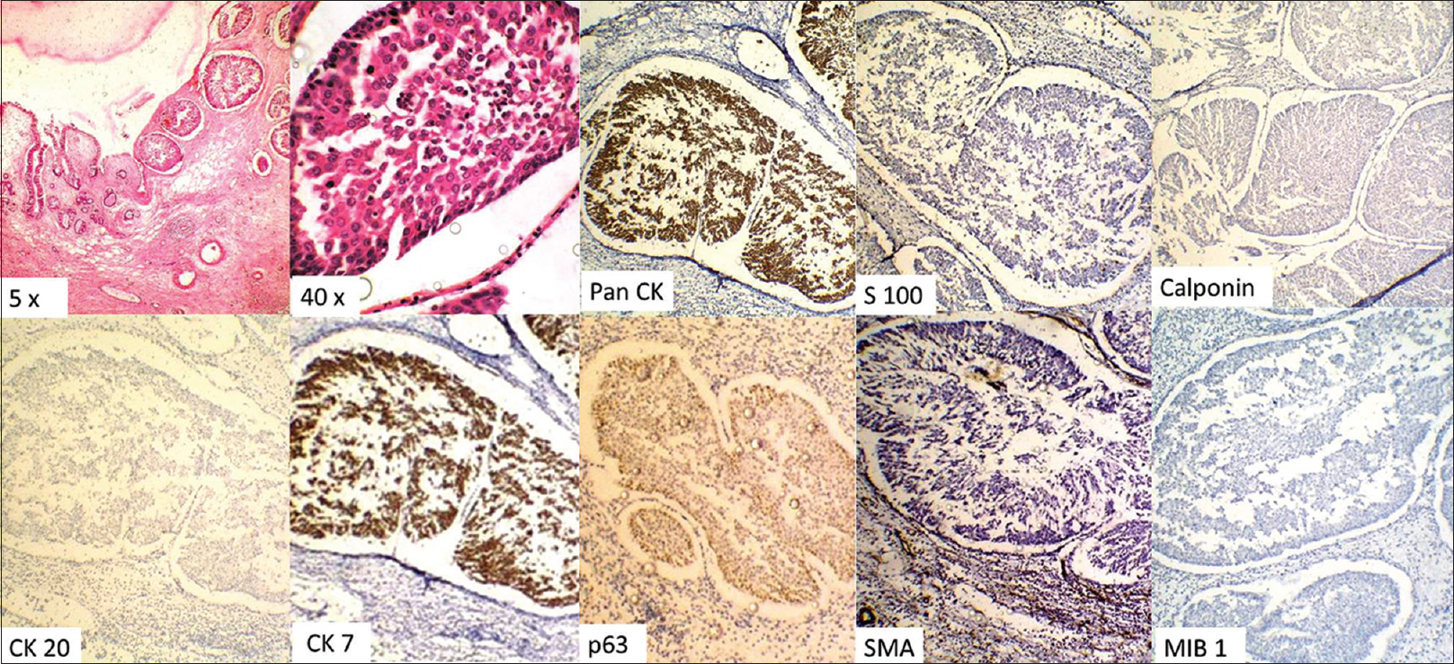 Composite photomicrograph showing hematoxylin and eosin stained section of the hamartomas glandular proliferation into the stroma, with the epithelial cells being positive for Pan cytokeratin and cytokeratin 7 and negative for S100, calponin, cytokeratin 20, and smooth muscle actin. The basal is seen to be positive for p63. The MIB-1 proliferative index is low