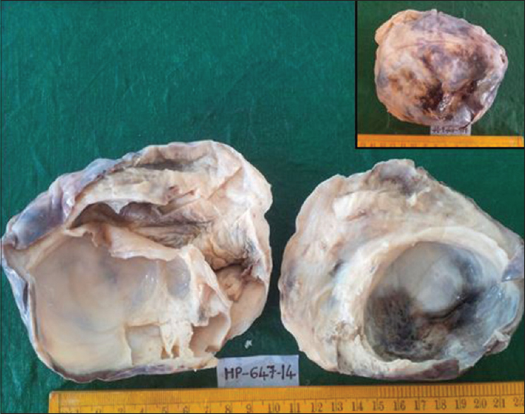 Left ovarian tumor with cut surface showing cystic and gray-white solid areas. Inset: Outer surface showing blackish areas due to torsion