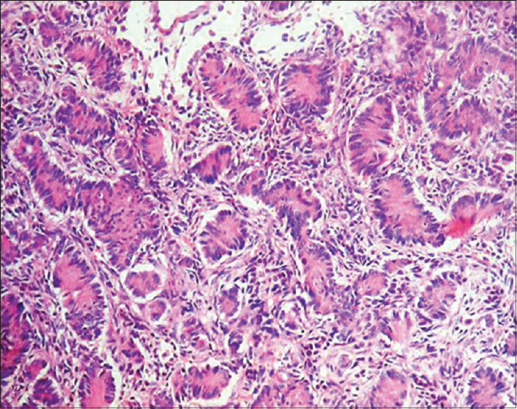 Microphotograph showing sertoliform endometrioid carcinoma showing tubules and tightly packed nests of tumor cells separated by fibrous stroma. Individual tumor cells having vesicular nuclei, prominent nucleoli, and moderate cytoplasm (H and E, ×400)