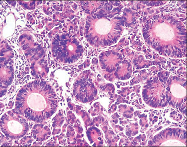 Microphotograph showing foci of conventional endometrioid carcinoma (H and E, ×400)