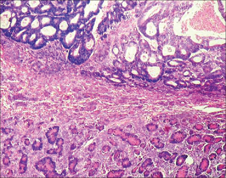Microphotograph showing foci of conventional endometrioid carcinoma and sertoli cell tumor-like pattern (H and E, ×200)