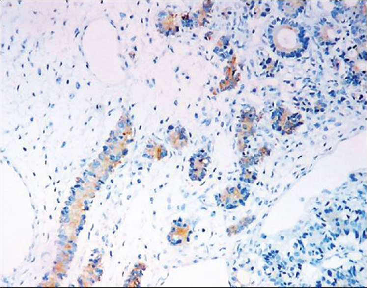 Sertoliform endometrioid carcinoma showing cytokeratin positivity (immunohistochemistry, ×200)