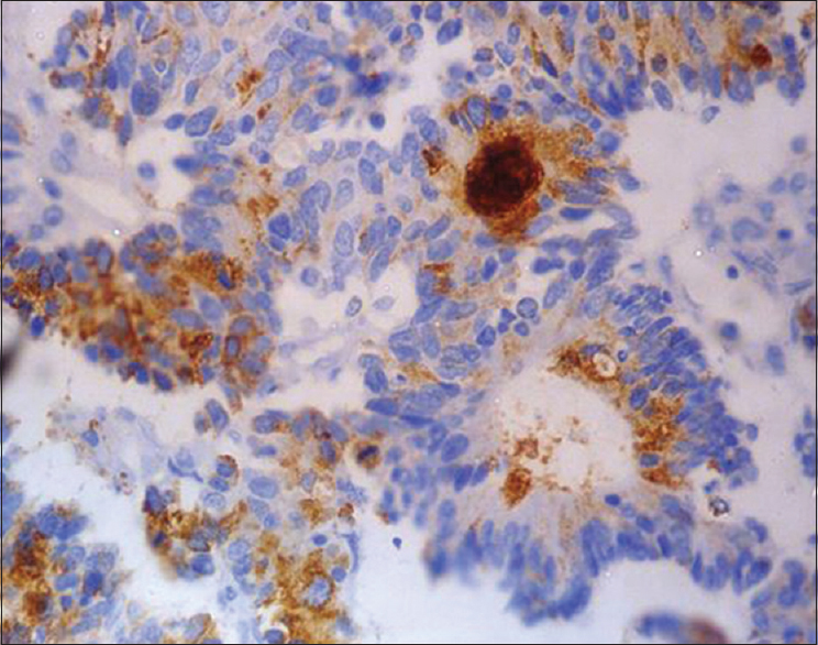 Sertoliform endometrioid carcinoma showing epithelial membrane antigen positivity (immunohistochemistry, ×400)