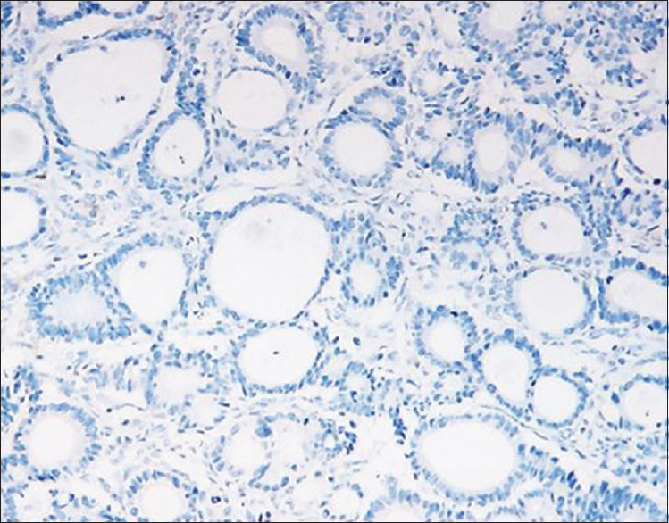 Sertoliform endometrioid carcinoma showing inhibin negativity (immunohistochemistry, ×400)