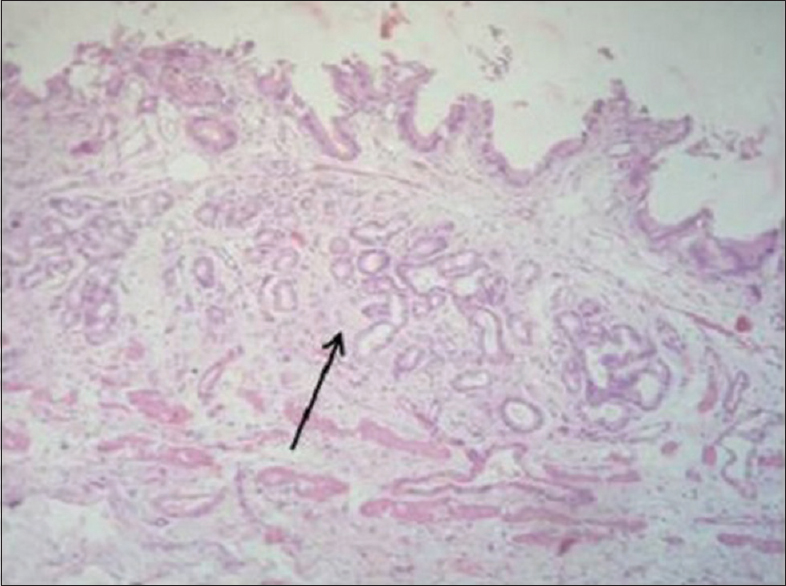 Photomicrograph showing pseudopyloric metaplasia in a separate focus along with features of chronic cholecystitis (H and E, ×40)