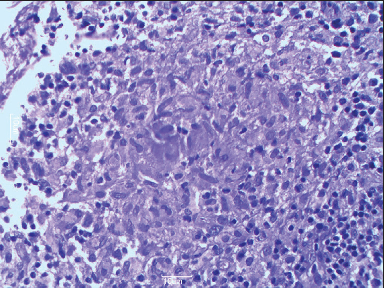 Photomicrograph showing aggregates of epithelioid cells and peripheral lymphocytes forming well circumscribed granuloma (H and E, ×40)