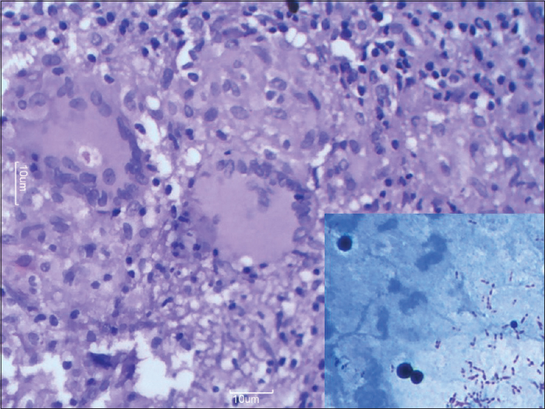 High power view showing numerous Langhans' giant cells and dispersed epithelioid cells (H and E, ×40). Inset shows many acid fast Bacilli (ZN, ×100)