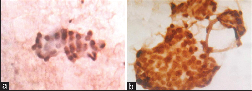 (a) Immunocytochemistry photomicrograph of breast carcinoma shows positive nuclear staining for progesterone receptor-Allred score-6-positive (×10), (b) Allred score-8-positive (×40)