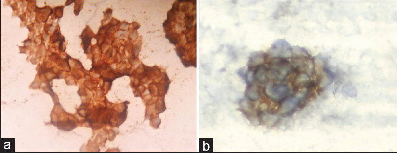 (a) Immunocytochemistry photomicrograph of breast carcinoma shows complete cytoplasmic membrane staining for human epidermal growth factor/neu–score-3+ (×10), (b) human epidermal growth factor/neu–score-3+ (×40)