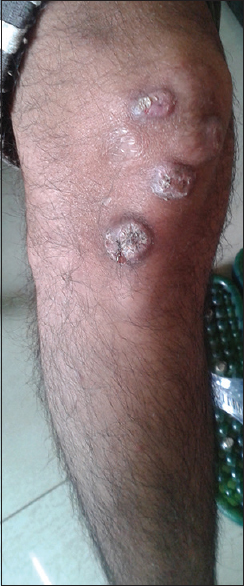 Nodular lesions on the right leg
