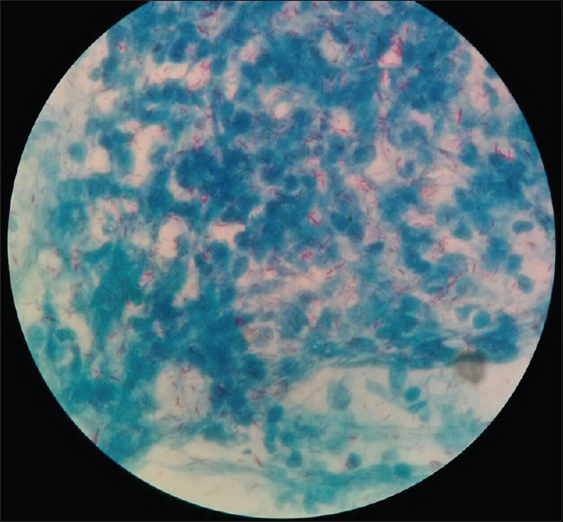 Acid-fast Bacilli in large numbers, grouped together in cigar-bundle appearance. Stained with modified Ziehl–Neelsen staining, ×100
