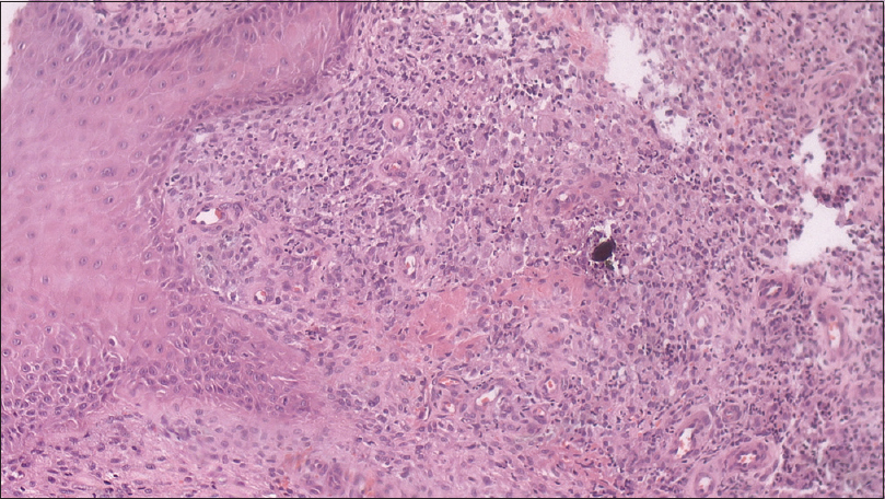 Dermis showing diffuse polymorphous inflammatory infiltrate with foamy histiocytes, neutrophils, plasma cells, and lymphocytes; stained with H and E, ×100