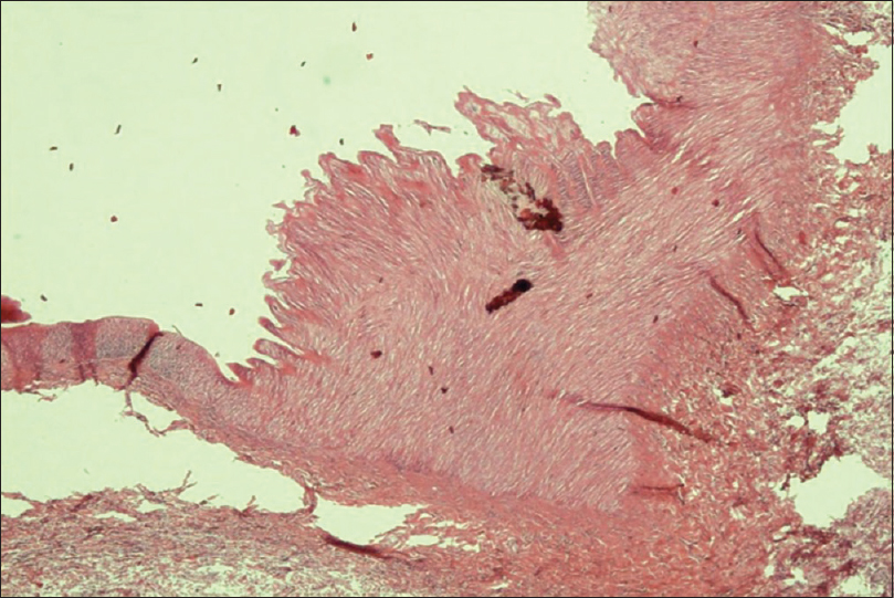 Internal carotid artery wall showing alternate thinning (arrow) and thickening of the tunica media. Medial walls with fibrosis (dysplastic changes) (H and E, ×40)