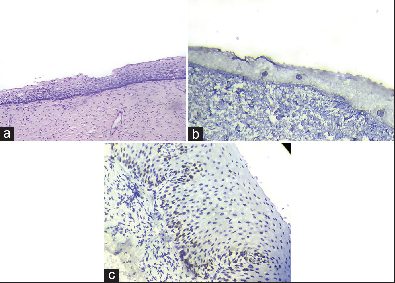 (a) Chronic cervicitis - Section shows normal squamous epithelial lining with sparse inflammatory infiltrate in the stroma (HPE [H and E, ×10, ×40]). (b) Negative immunostaining in a case of chronic cervicitis (p16INK4a [IHC, ×10, ×40). (c) Negative immunostaining in a case of chronic cervicitis (Ki-67 [IHC, ×10, ×40])