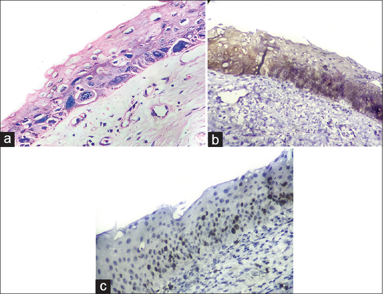 (a) Cervical intraepithelial neoplasia I - Section shows crowding of cells in the basal third of the epithelium. Nuclei are enlarged, hyperchromatic, and show loss of polarity. Few cells exhibiting koilocytotic atypia are seen (HPE [H and E, ×10, ×40]). (b) Section shows moderate nuclear and cytoplasmic staining of the lower 1/3 of epithelium in cervical intraepithelial neoplasia I; Score 5 (p16INK4a [IHC, ×10, ×40]). (c) Positive immunostaining in the nuclei of lower two-third of the epithelium in cervical intraepithelial neoplasia I; 60% positivity, Score 3 (Ki-67 [IHC, ×10, ×40])