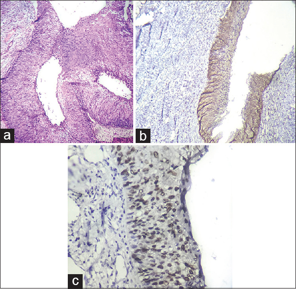 (a) Cervical intraepithelial neoplasia III - Section shows crowding of cells in the full thickness of the epithelium. Nuclei are enlarged, hyperchromatic, and show loss of polarity. Few mitotic figures noted (HPE [H and E, ×10, ×10]). (b) Section shows diffuse strong positive cytoplasmic and nuclear staining in full thickness of the epithelium in cervical intraepithelial neoplasia III; Score 8 (p16INK4a [IHC, ×10, ×10]). (c) Diffuse strong nuclear positive immunostaining in full thickness of the epithelium in cervical intraepithelial neoplasia III; 80% positivity, Score 3 (Ki-67 [IHC, ×10, ×40])