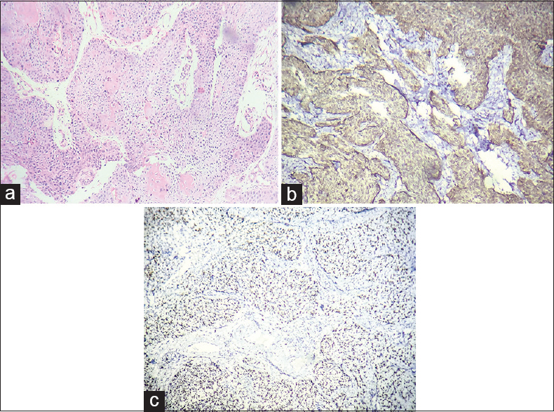 (a) Squamous cell carcinoma - Section shows a tumor displaying features of invasive squamous cell carcinoma (HPE [H and E, ×10, ×10]). (b) the tumor shows strong diffuse cytoplasmic and nuclear positivity in SCC; Score 8 (p16INK4a [IHC, ×10, ×10]). (c) Diffuse strong nuclear positivity in the tumor cells in SCC; 90% positivity, Score 3 (Ki-67 [IHC, ×10, ×10])