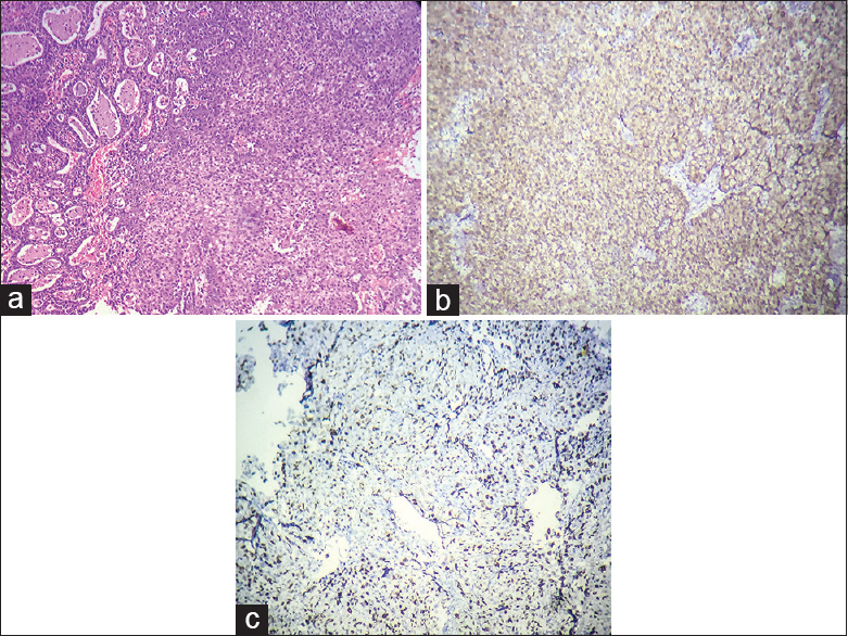 Adenocarcinoma - Section shows a tumor displaying features of invasive endocervical adenocarcinoma (HPE [H and E, ×10, ×10]). (b) Tumor cells show strong diffuse cytoplasmic and nuclear positivity in adenocarcinoma; Score 8 (p16INK4a [IHC, ×10, ×10]). (c) Diffuse strong nuclear positive immunostaining in adenocarcinoma; 90% positivity, Score 3 (Ki-67 [IHC, ×10, ×10])