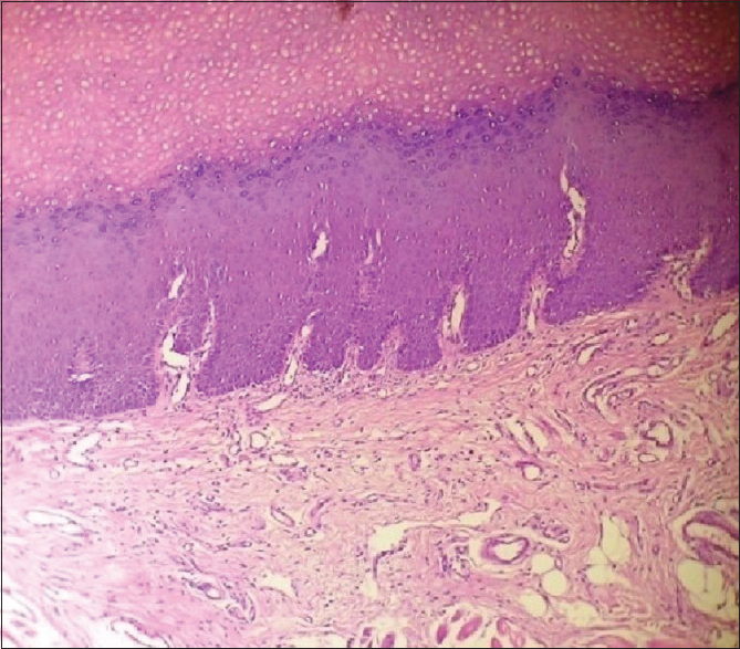 Low-power photomicrograph (H and E, ×10) showing hyperplastic epithelium with hyperparakeratosis and elongated rete ridges and chronic inflammation of the underlying connective tissue