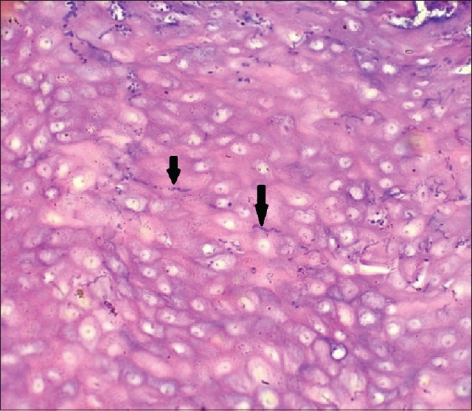 High-power photomicrograph (H and E, ×40) showing candidal hyphae (black arrows) in epithelium