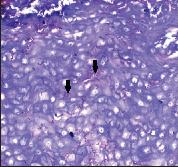 High-power photomicrograph (PAS, ×40) showing candidal hyphae (black arrows) stained magenta red