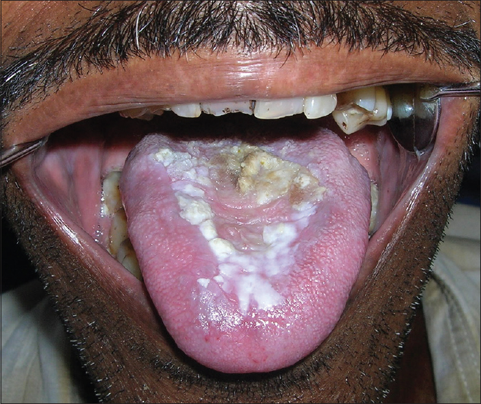 Intraoral photograph showing partial resolution of the lesion 2 weeks after antifungal therapy