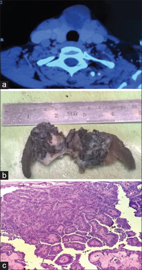 (a) Contrast-enhanced computed tomography - Predominantly cystic well-defined mass in isthmus with calcific foci and irregular enhancing component. (b) Grossly cystic mass in the isthmus with focal solid areas. (c) Sections from isthmus mass showed papillary carcinoma thyroid (H and E, ×200)
