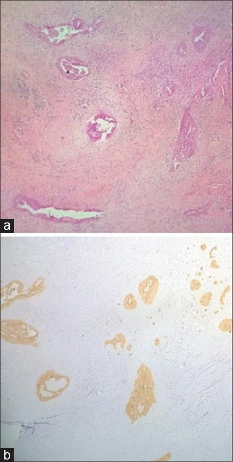 (a) Tumor showed several similar foci (H and E, ×40). (b) Cytokeratin 19 positivity in these foci (×40)