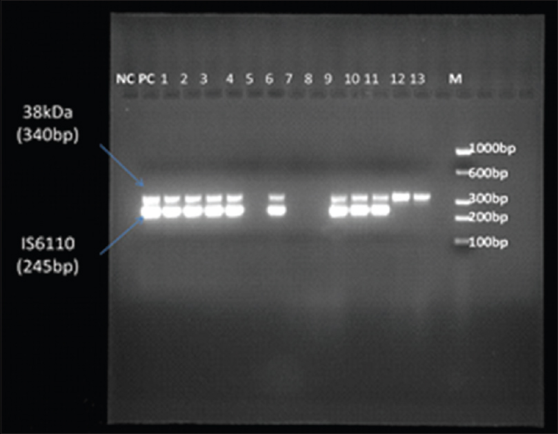 Gel photograph showing the result of multiplex polymerase chain reaction. Multiplex polymerase chain reaction with 38 kDa (340 bp) and IS6110 (245 bp) genes of Mycobacterium tuberculosis in cerebrospinal fluid samples. Lane M = Molecular marker, PC = axControl DNA of H37RV and 1–13 are sample