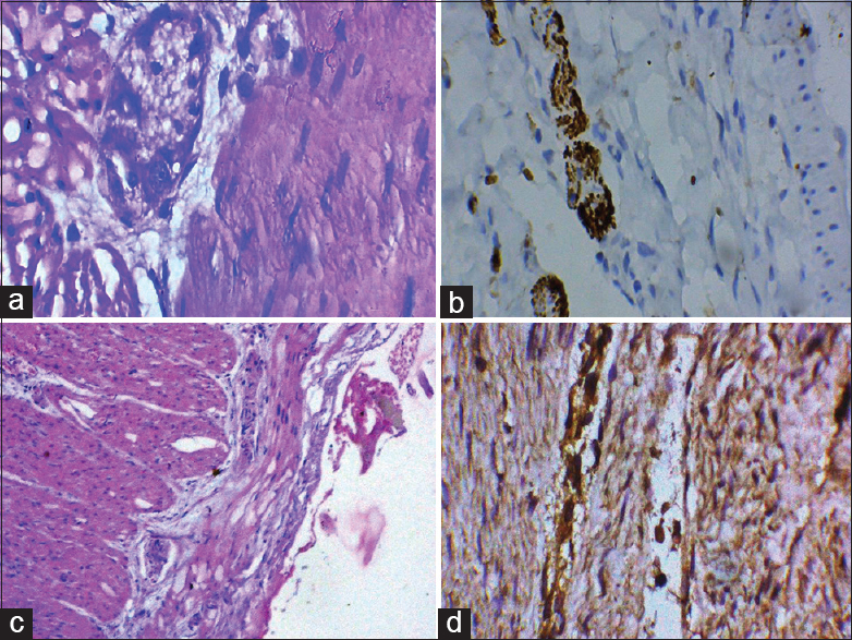 (a) Mature ganglion cells in myenteric plexus (×400); (b) calretinin positive immunohistochemistry; (c) hypertrophic nerve fibers; (d) acetylcholine positive nerve fiber
